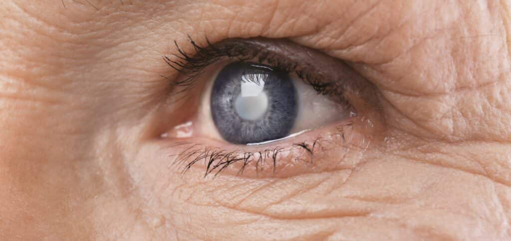 Cataract senior woman's eye closeup