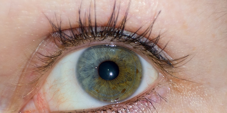 Abnormal Eyelashes
